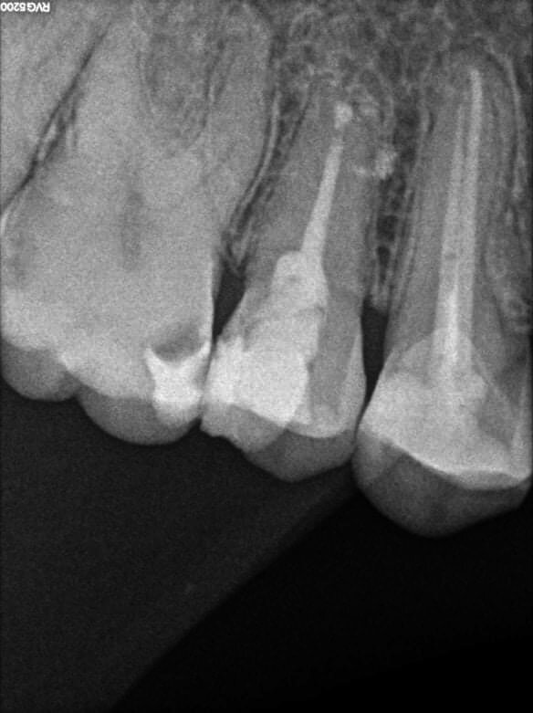 Fig. 2m: Two years follow-up radiograph.