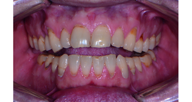Digital planning for full mouth reconstruction