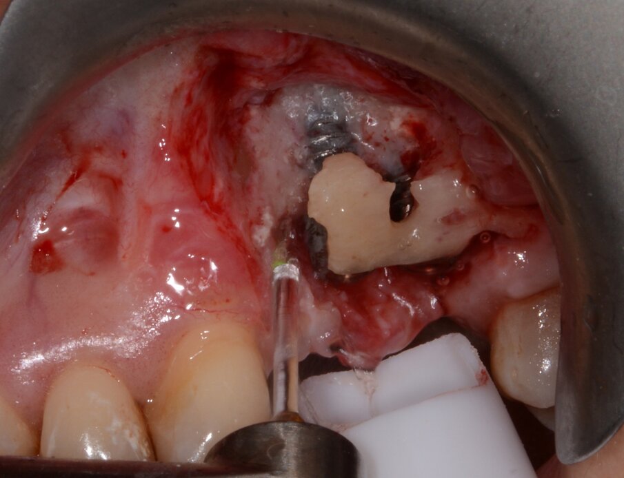 Fig. 10: Granulation tissue removal with Er:YAG laser. 
