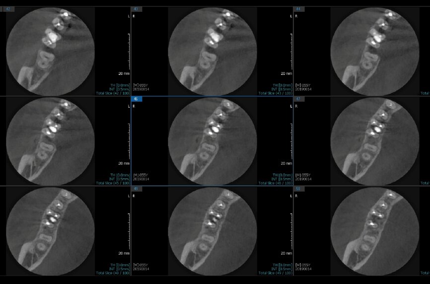 Fig. 6e: Post-op CBCT images of tooth #46 showing adequately obturated canals at all levels to the working length and sealing of the furcation defect.