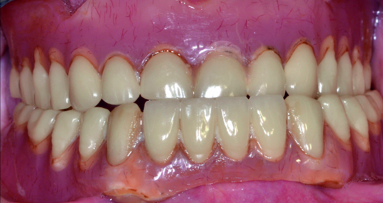 Veneering options for fixed implant-retained restorations