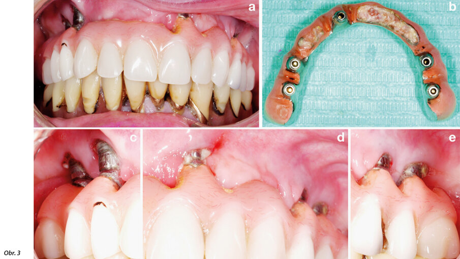 Obr. 3: Nestabilní parodontální stav (a) a nedostatečné instrukce ohledně orální hygieny (b–e) zvyšují riziko vzniku periimplantátového onemocnění (c–e).  © Dr. K. Bertl