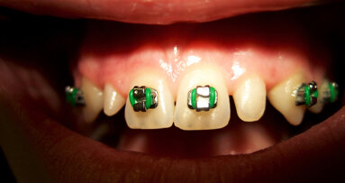 Direct composite restorations in orthodontic indications