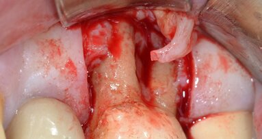Ruolo della chirurgia osseo-resettiva nella terapia delle lesioni endo-parodontali: descrizione di un caso clinico