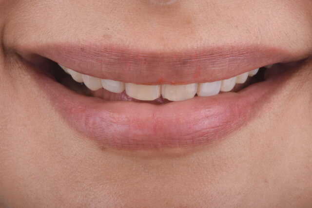 FIg 3A: Frontal smile view Before