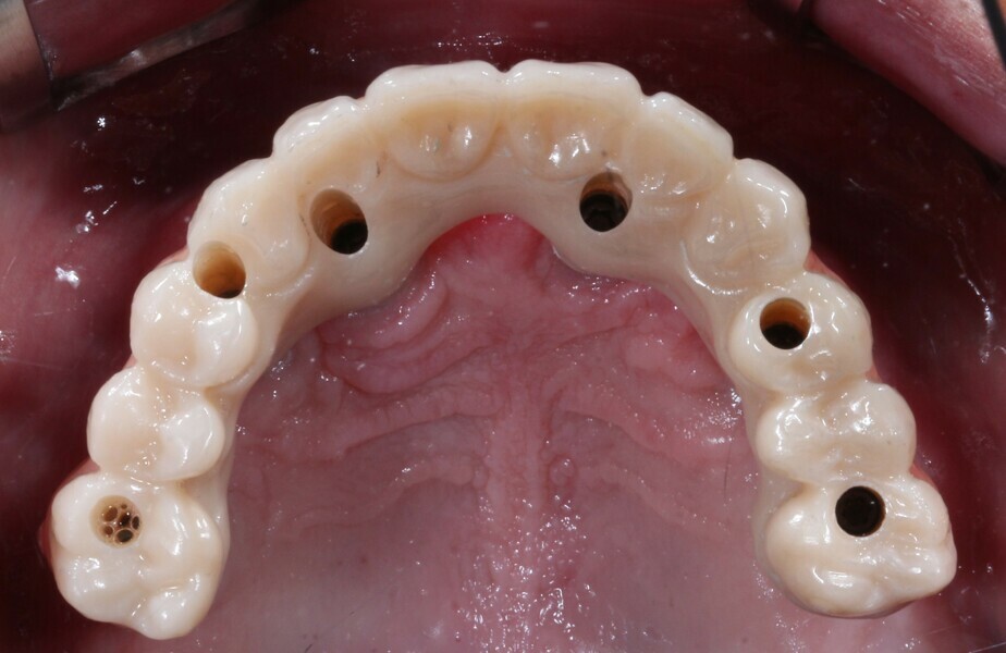 Fig. 21: Final maxillary prosthesis, occlusal view.