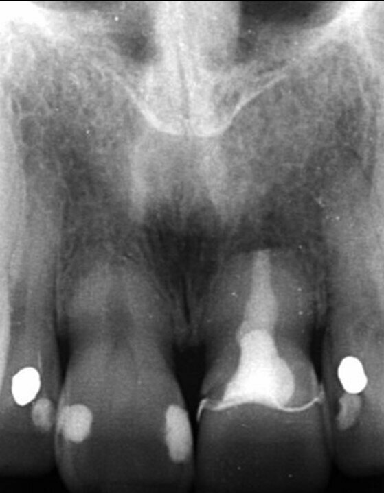 Fig. 3: Pre-op periapical radiograph.