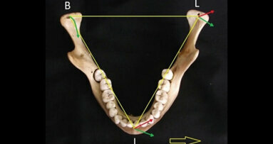 Condylar retrusion on the horizontal plane associated with retrusive lateral excursion