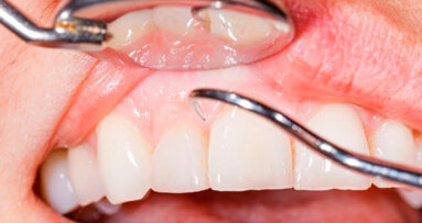 Tasche parodontali profonde mettono a repentaglio la salute orale