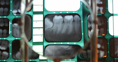 Artificial intelligence shows promise for detecting periodontal status in bitewing radiographs