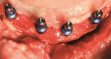 3-D alveolar ridge reconstruction in a case with severe bone loss