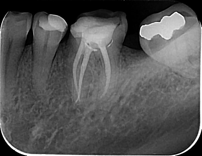 Slika 1. Trodimenzionalna opturacija prvog donjeg molara