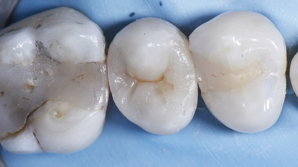 Large MODL Class II restoration with ceram.x® SphereTEC one, Palodent® V3 and SDR® Plus