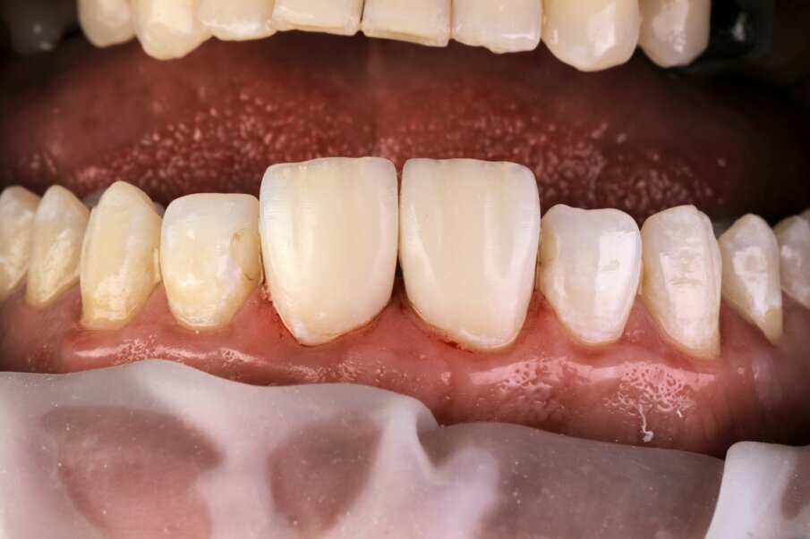 Fig. 14: Initial finishing and polishing after build-up of the direct veneers on tooth #11, 21.