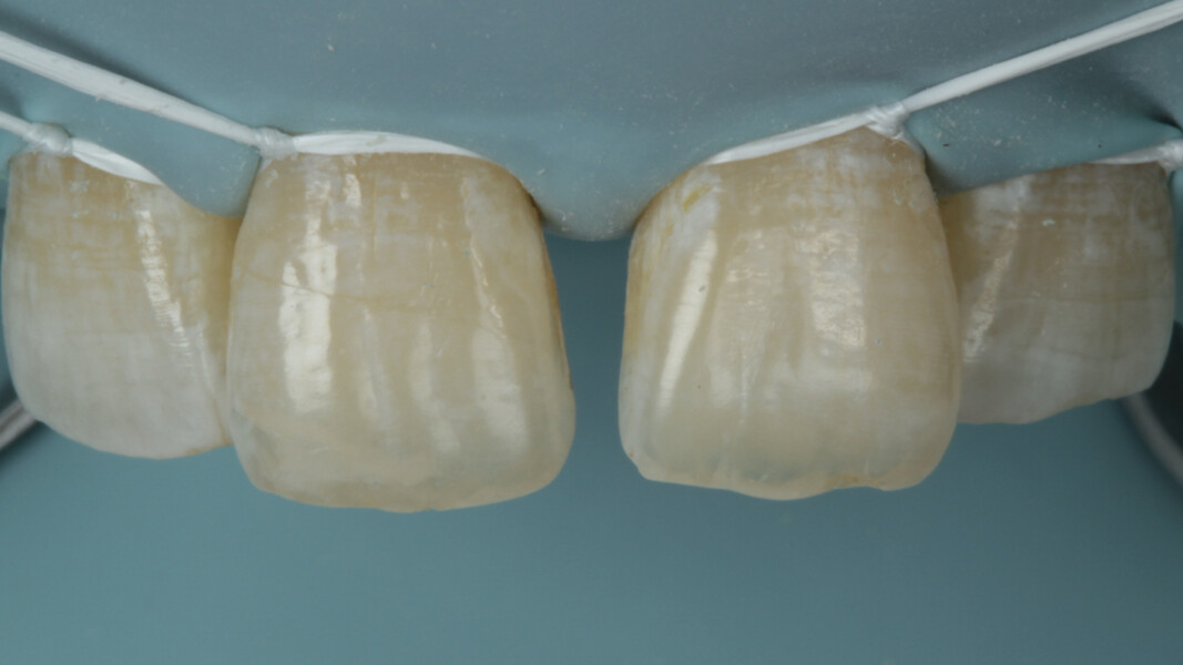 Fig 7.  After thorough prophylaxis, the concerned site was isolated with rubber dam and further retraction of gingiva was achieved with the help of floss ties. A good retracted area gives good access and visibility for the restoration and hence the desired emergence profile.