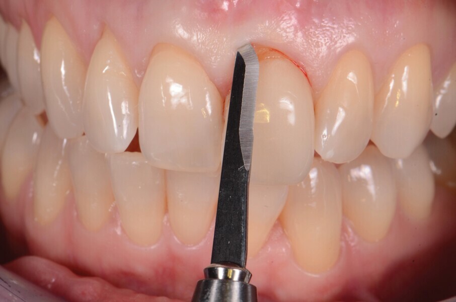 Fig. 4 : Extraction atraumatique de la dent 21. 