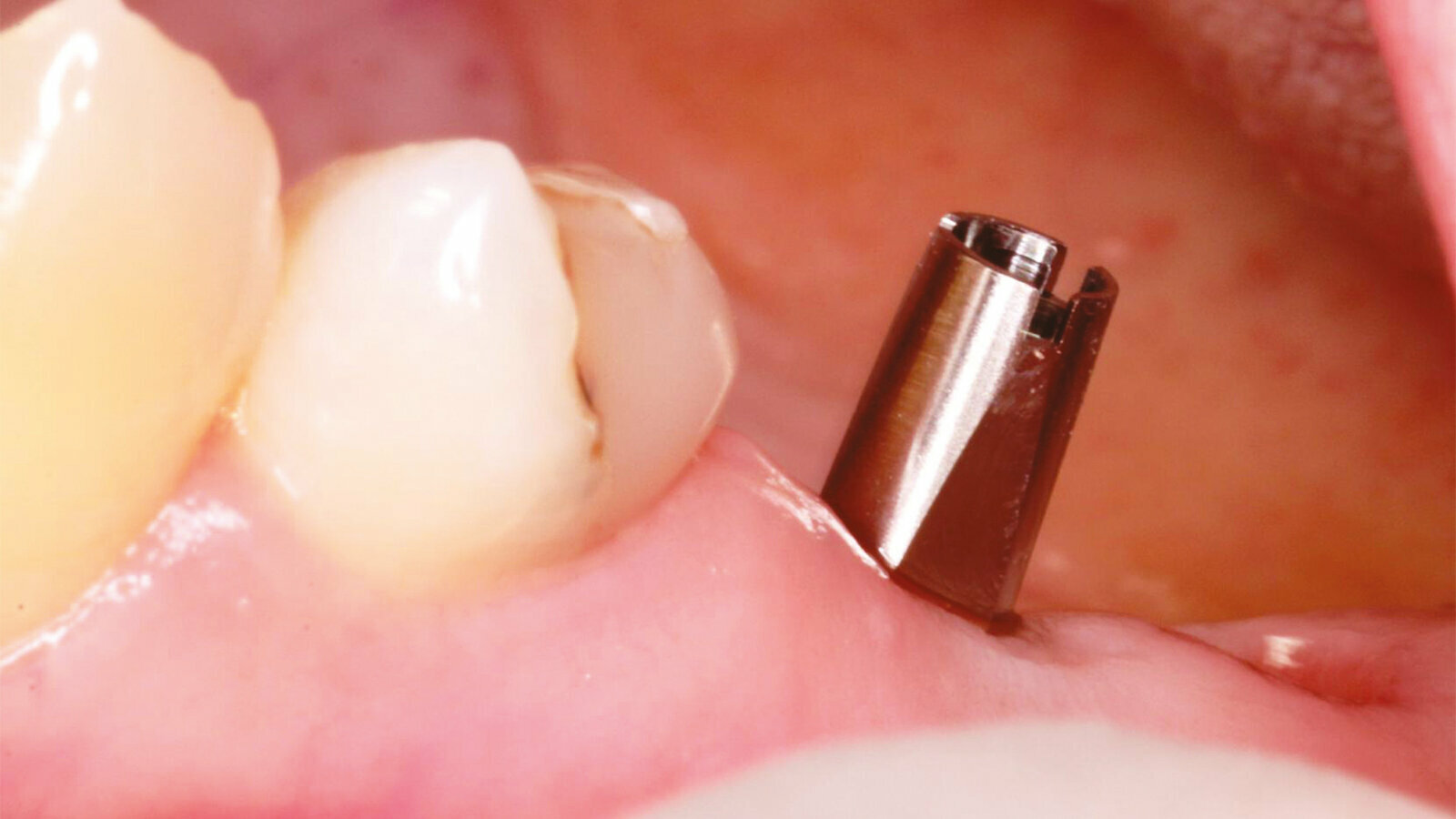 Achieving a higher standard in implant therapy for your patients
