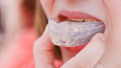 Researchers develop mouth guard for illuminating early signs of cavities