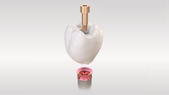 Kooperation von TRI Dental Implants und Amann Girrbach: Implantate ohne Abutment im vollstädig validierten Workflow