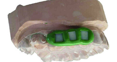 Adhésion de nanoparticules d’hydroxyapatite (HA) aux matériaux dentaires