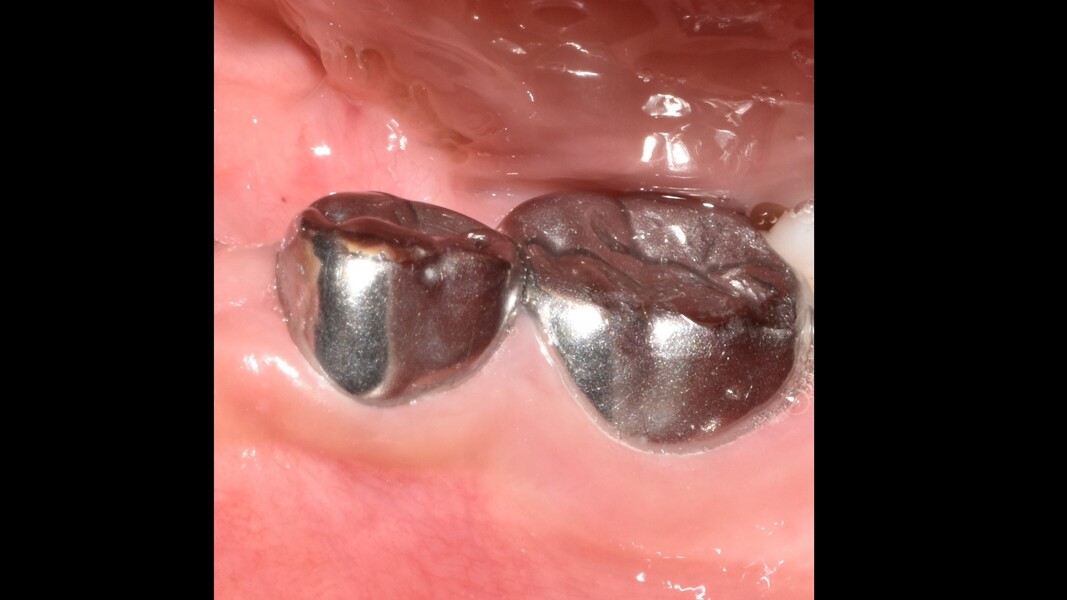 Fig. 9: Clinical aspect at final evaluation showing healthy gingival tissue.