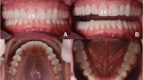 Fig. 14. Fotografías intraorales del tratamiento finalizado. a y b Vista frontal. c Vista oclusal de la mandíbula superior. d Vista oclusal de la mandíbula inferior.