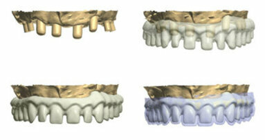 The use of CBCT and CAD/CAM techniques in implant-supported rehabilitation of maxilla—Part II