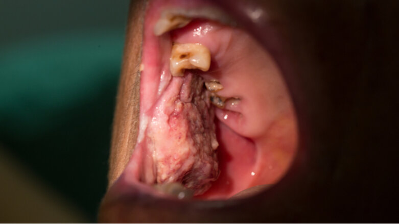 Cancerul oral poate trece nedetectate în timpul crizei COVID-19