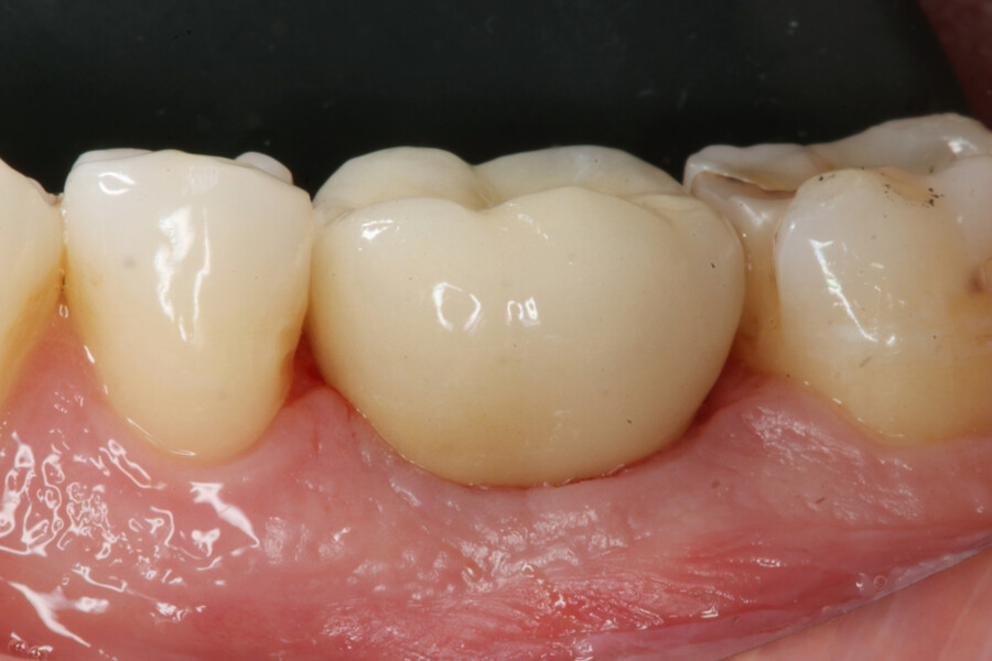 Fig. 17: Clinical situation after seating of final zirconia crown.