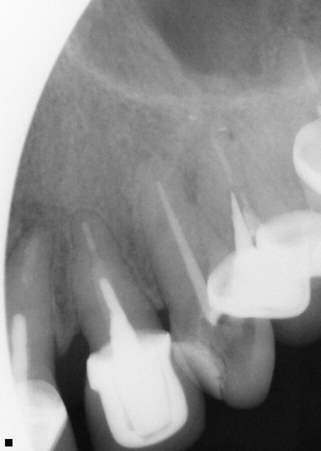 Fig. 13: Tooth 11 following instrumentation with ExactTaperH DC files and obturation with a single cone GP matching the final file size and Bioceramic Root Canal sealer.