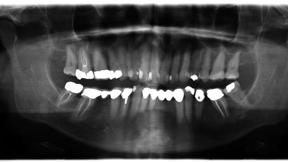 CBCT as a diagnostic and treatment planning tool and assessment of low dose programs for endodontic follow-up cases
