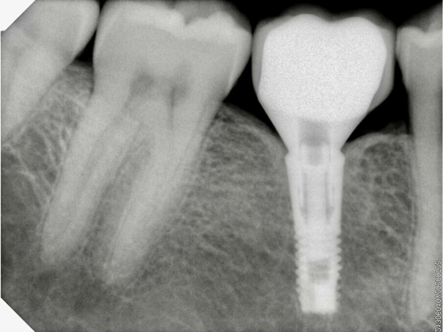 Fig. 17: After ten years, the radiograph showed a perfect fit of the restoration, the spaces created for the interproximal papillae and the position of the bone at the level of the implant.