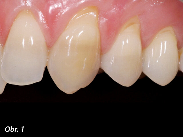 Obr. 1: Malé oblasti s úbytkem skloviny v krčkové části zubů, které vedou k vystavení dentinu iniciačním podnětům, zejména chladu a vzduchu, a tedy k bolestivé hypersenzitivitě dentinu.