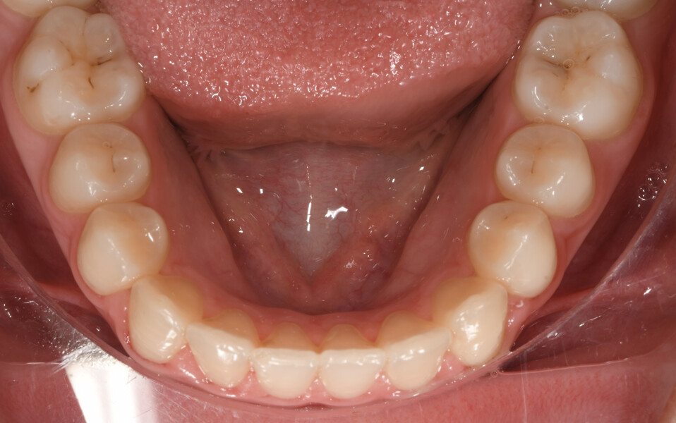 Fig. 19: Final  intra-oral photograph. 