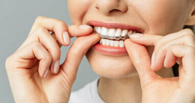 Nhiều cơ quan nha khoa chuyên nghiệp đạt được sự đồng thuận về chỉnh hình răng tự làm