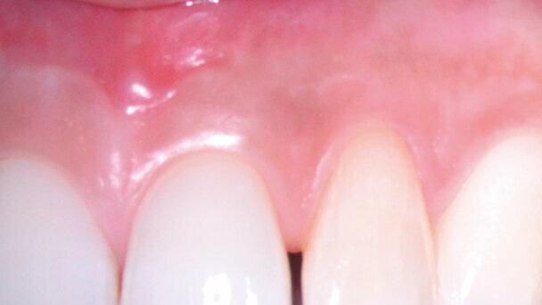 Endodonzia chirurgica: una terapia predittiva e affidabile per conservare il dente naturale