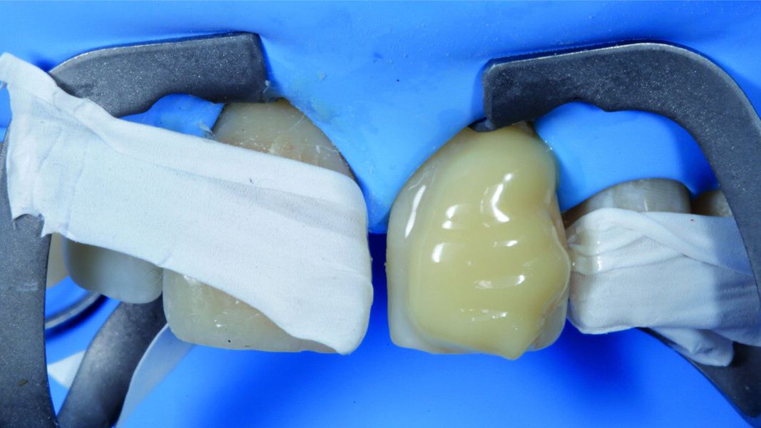 Fig. 16: Bifix QM luting system (VOCO) applied to the tooth #21 stump and PTFE tape covering the adjacent teeth.