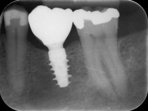Fig. 22: One-year follow-up radiograph.