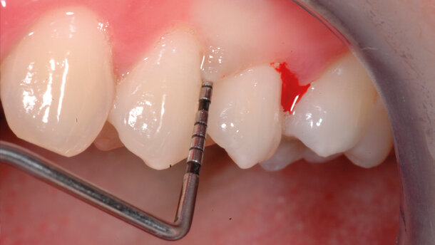 Terapia parodontale non chirurgica con approccio “One-Stage Full-Mouth Disinfection”