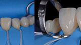 Fig. 16a. Aislamiento y prueba del ajuste de las carillas en los dientes # 11 y 21.