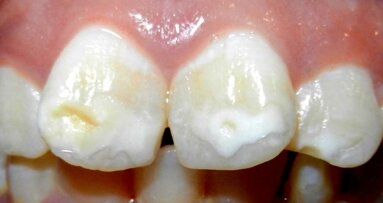 Colgate lanza un Advisory Board sobre mancha blanca en ortodoncia