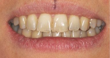 Lingvální zámky 3M™ Incognito™ System a kombinovaná ortodontickochirurgická terapie