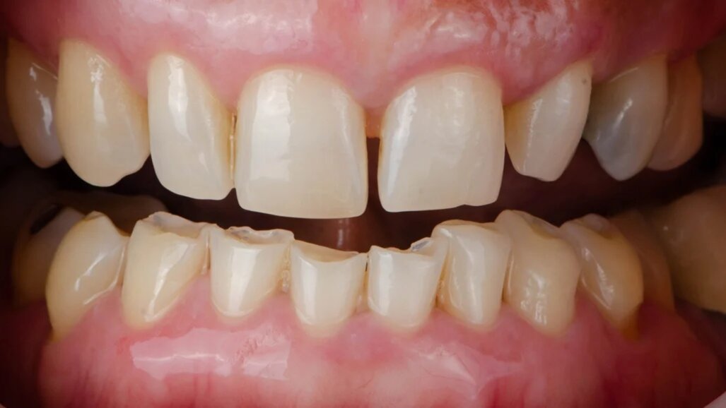 Износване на зъбите и бруксизъм: Скритата борба в денталната медицина