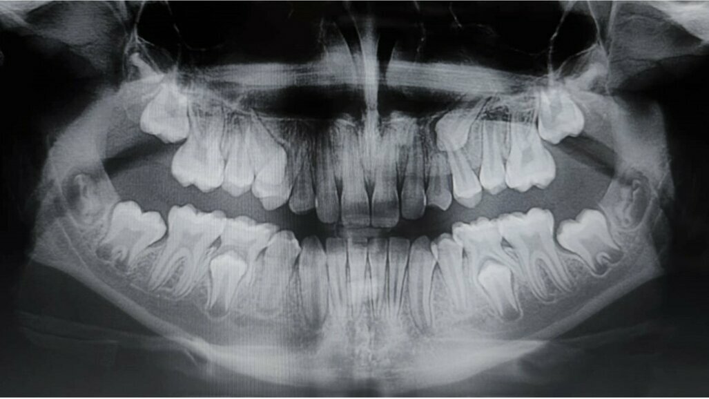 Management ortodontico delle trasposizioni dentali
