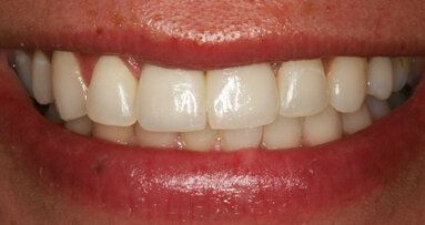 Management of two implants in the esthetic zone
