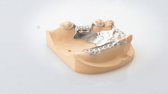 Dentures produced using 3-D printing versus casting and milling