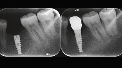 Low implant insertion torque allows minimal bone loss: A multicenter two-year prospective study