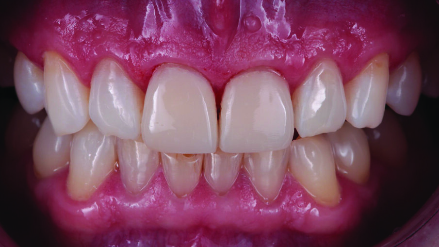 Treatment outcome immediately after rubber dam removal. The discolorations were gone, the restorations and the adjacent teeth had a similar shade, and a natural shape was achieved.