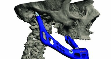 LayerWise construit le premier implant personnalisé de reconstruction mandibulaire totale