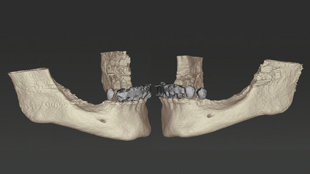 Riabilitazione di una mandibola atrofica con programmazione 3D